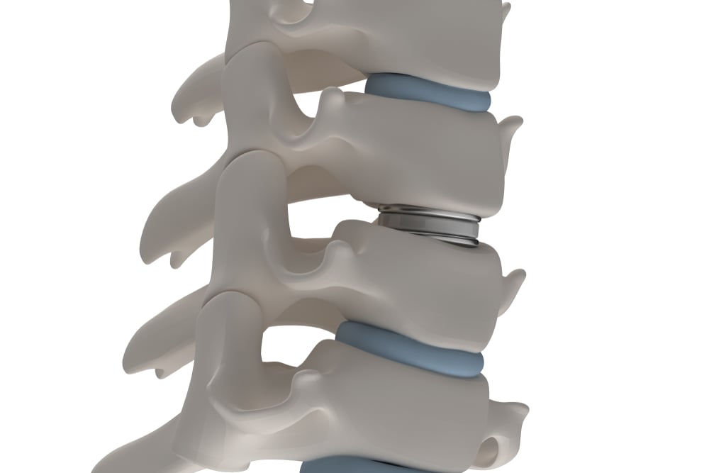 spinal implant fraud